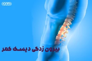 بیرون زدگی دیسک کمر